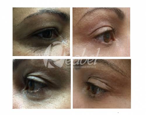 BLEFAROPLASTIA SIN CIRUGIA